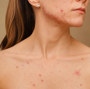 mulher com acne da mulher adulta
