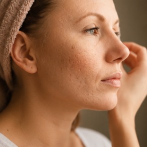 mulher com cicatrizes de acne na face
