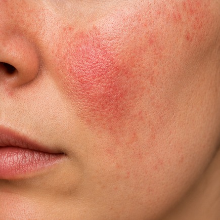 mulher com rosácea eritematotelangiectásica