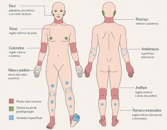 Locais mais frequentes da dermatite atópica em adolescentes e adultos
