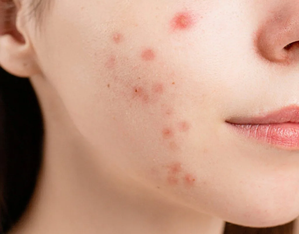 Rosto feminino com acne: espinhas e cravos