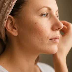 mulher com cicatrizes de acne na face