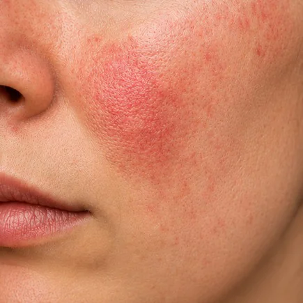 mulher com rosácea eritematotelangiectásica