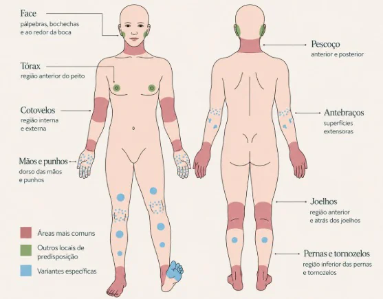 Locais mais frequentes da dermatite atópica em adolescentes e adultos