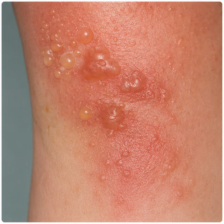 dermatite de contato alérgica com bolhas