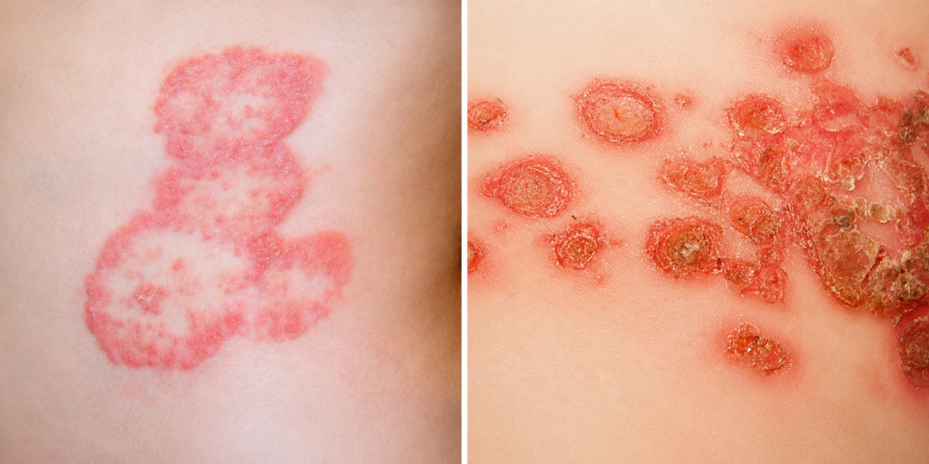 Fotos de impetigo e tinea, duas infecções frequentes em crianças na dermatologia pediátrica