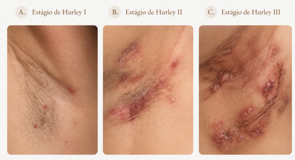 Imagem demosntrando os 3 níveis da classificação de Hurley da Hidradenite supurativa