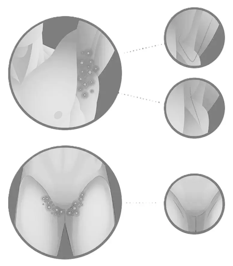 foto contendo diagrama com os principais locais afetados pela hidradenite supurativa