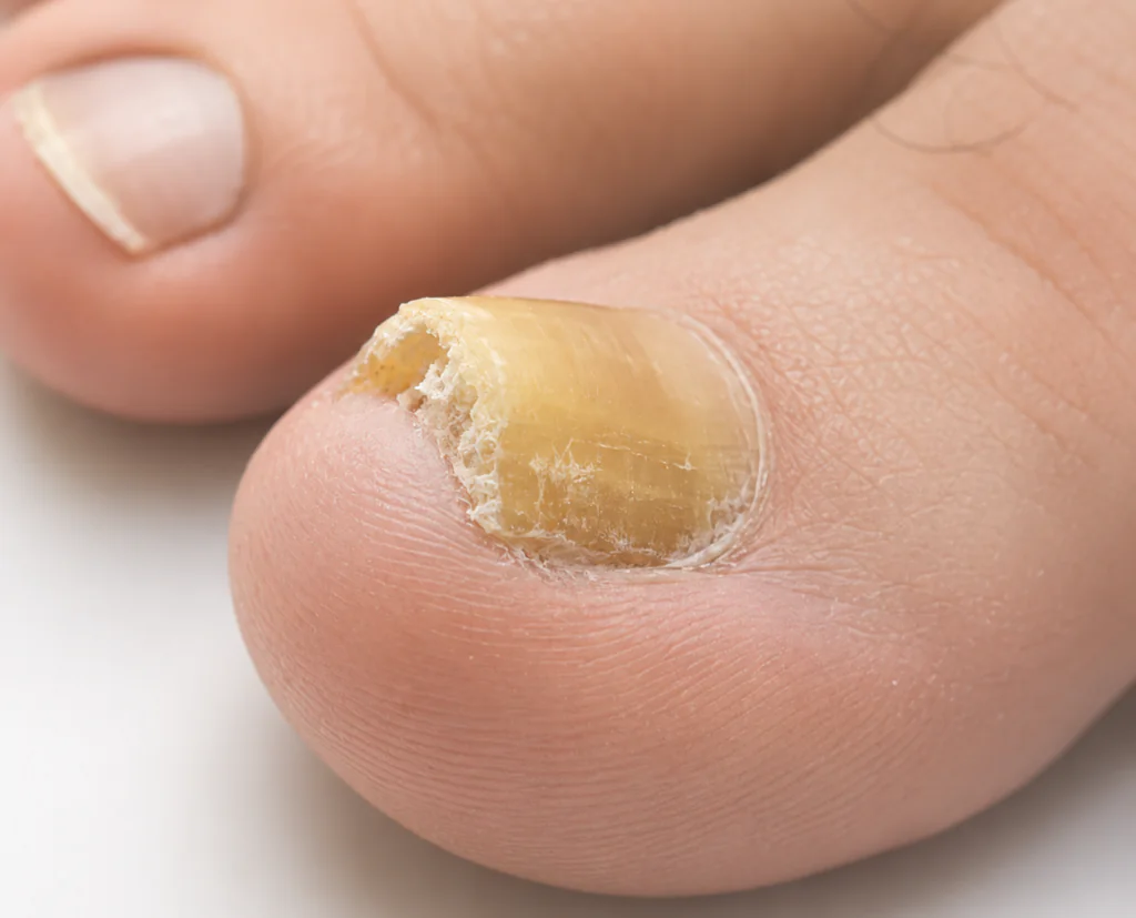 Unha do hálux com onicomicose distal lateral moderada.