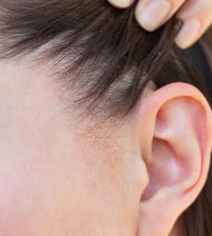 Dermatite Seborreica na região pré auricular, no couro cabeludo