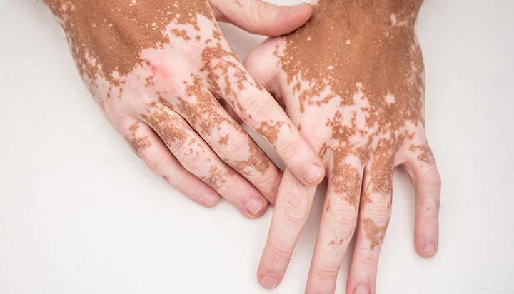 foto de mãos morenas com manchas brancas de vitiligo
