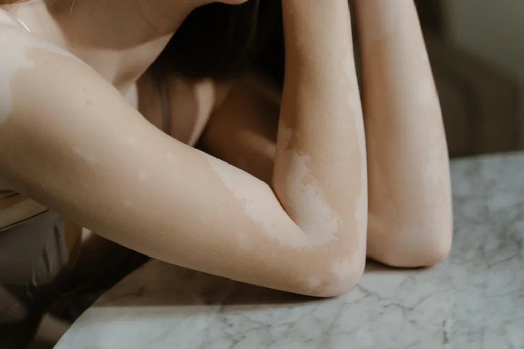 foto contendo os braços de uma mulher com manchas brancas resultantes de vitiligo