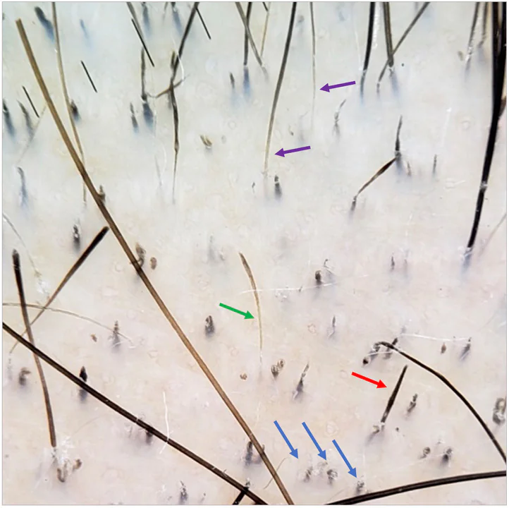 tricoscopia da alopecia areata