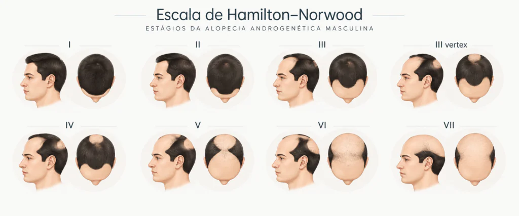 imagem da escala de Hamilton-Norwood demonstrando diferentes graus da calvície masculina